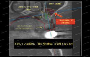 サイナスリフト、骨再生・造成を計画します